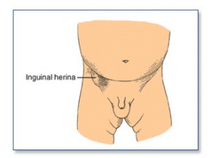Laparoscopic Inguinal Hernia Repair « Dr. Dana L. Reiss